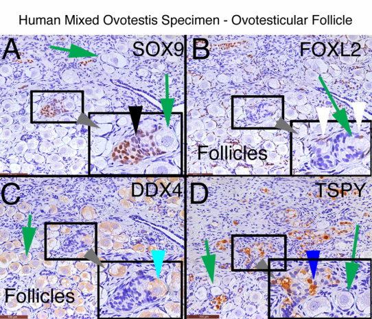 Human Mixed Ovotestis Specimen- Ovotesticular Follicle